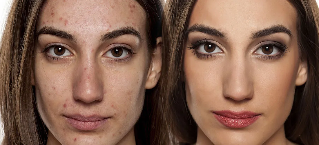 the_skin_factory_acne